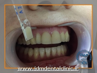 قبل از انجام درمان