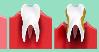 بررسی ارتباط سطح سرمی ویتامین D و کلسیم با پوسیدگی دندانی در کودکان 12-6 ساله