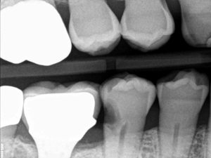 عکس 1: پوسیدگی‌های گسترده اینترپروکسیمال 